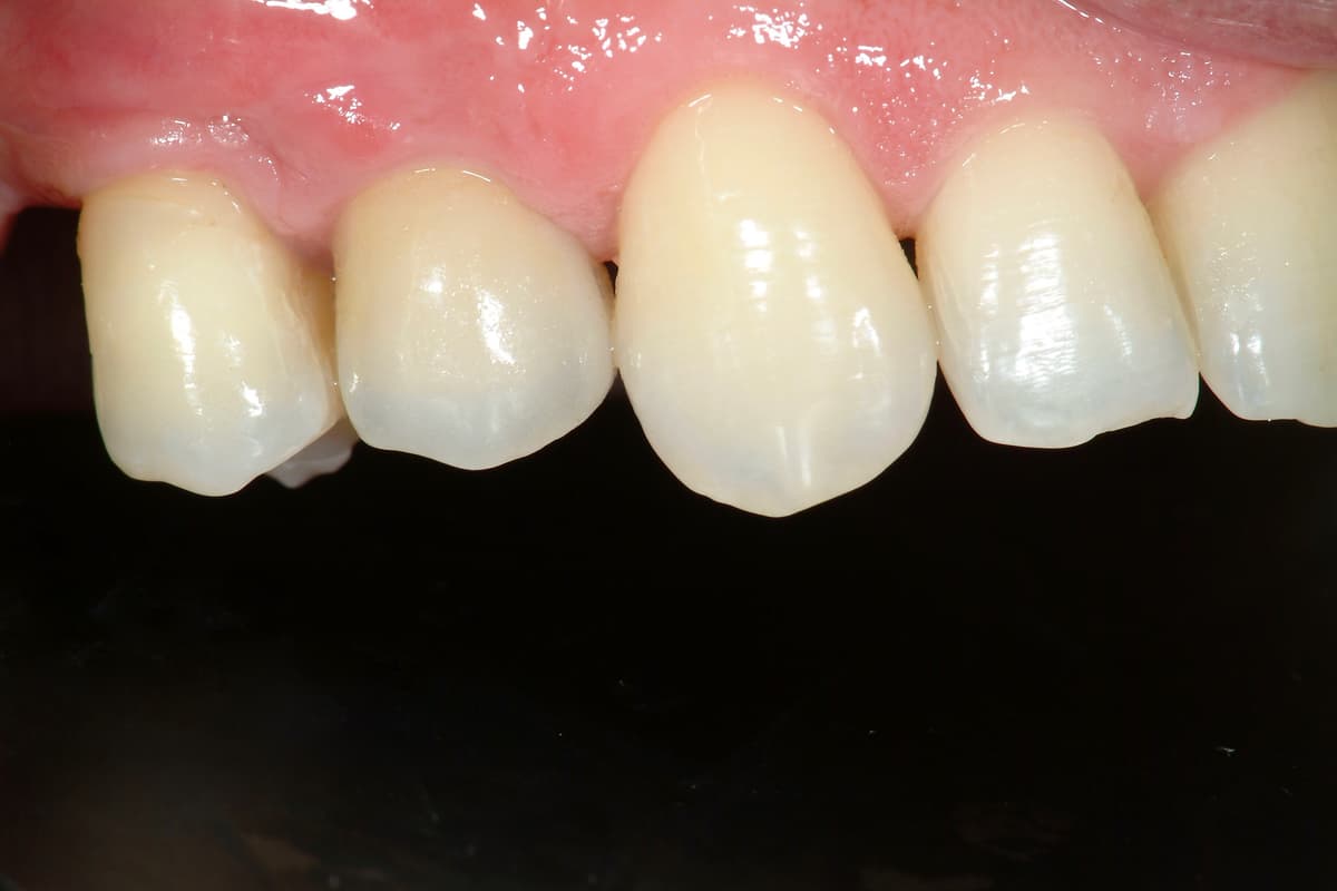 Riabilitazione implanto-protesica su dente fratturato